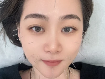 面针五次以后的感受~