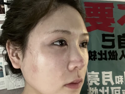 面颊凹了别焦虑!脂肪三天填回来