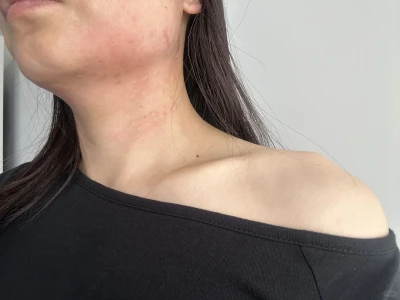 40+第一次打肉毒