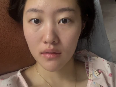 记录打完光子嫩肤的一段时间后