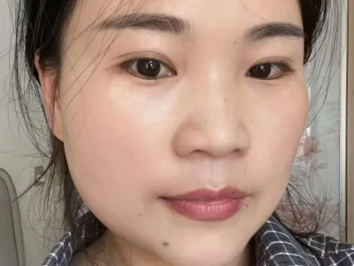 打卡三个月，倔强的黄褐斑不见了