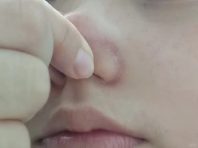 毛孔粗大,感觉自己丑丑的😭😭😭