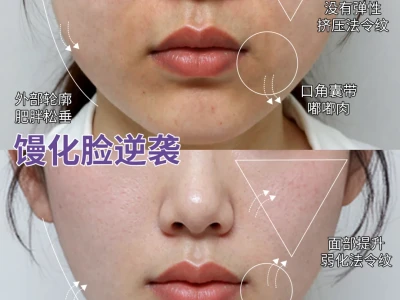 从馒化脸到轻薄脸❗3步告别浮肿