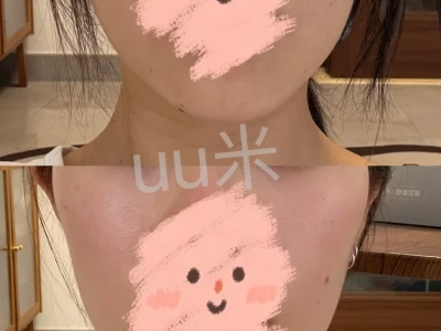 关于打下颌缘提升及咬肌的小小后续