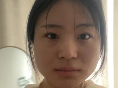 瘦脸针第10天📝