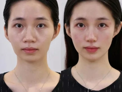 #高级脸🆚对比 凹陷苦相脸爆改元气少女
