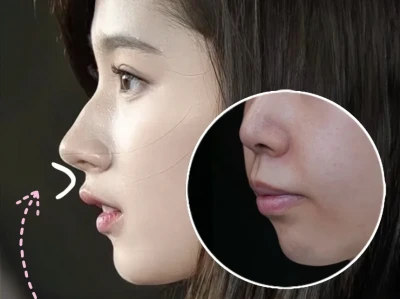 我发现嘴凸的姐妹按sana模板来微调才是真美