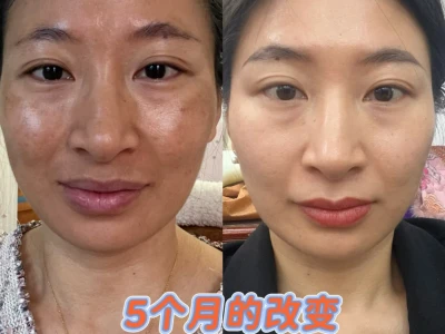 真不是换脸✔️5个月皮肤的惊人蜕变