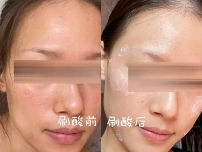 大毛孔 + 泛红脸有救了！刷酸给我换脸…