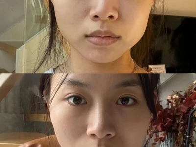 瘦脸针一个月了,对比看看