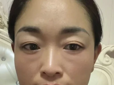 记录我大半年黄褐ban是如何淡掉的!