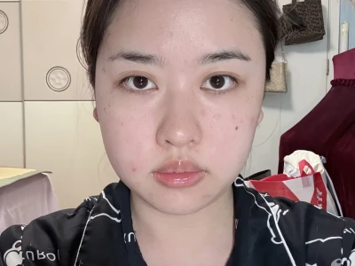 方圆脸瘦脸针三个月前后对比