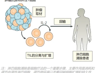 研报||肿瘤浸润淋巴细胞(TIL)疗法行业现状与发展趋势报告