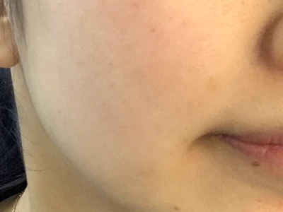 玫瑰痤疮好皮打卡记录