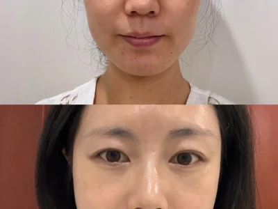 北京30+脸垮 太阳穴凹 用童颜一个月了咋样