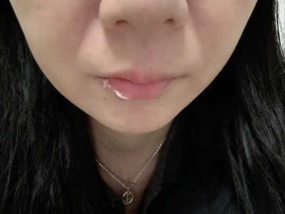 苹果肌下垂怎么办?
