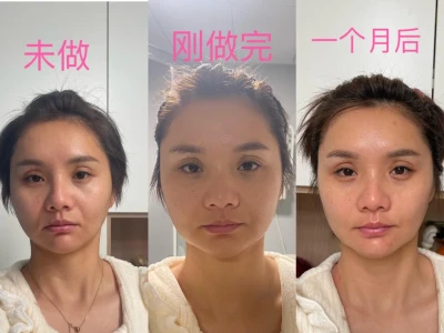 都说童颜💉后一月效果最佳