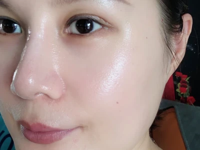 黄褐斑的苦尽甘来