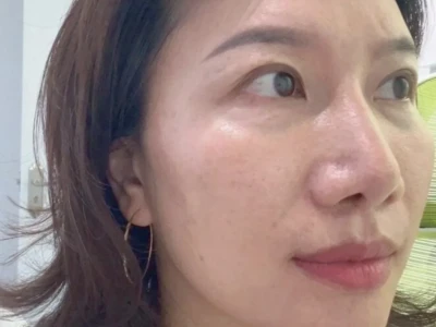 80后10年黄褐斑打卡82天