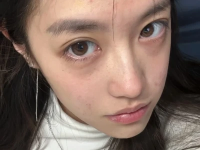 好爱雀斑