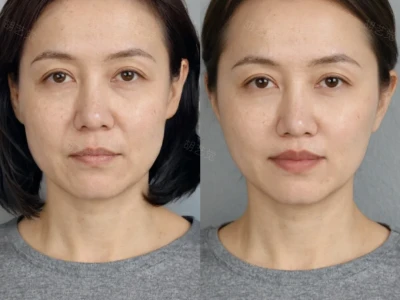 40+抗衰 告别面部‘松垮垂’,自然年轻态~