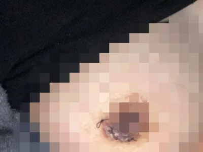 乳腺恢复这样正常吗?