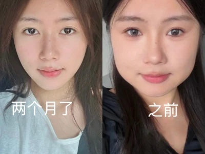 瘦脸+下颌缘两个月,真的有点离不开了