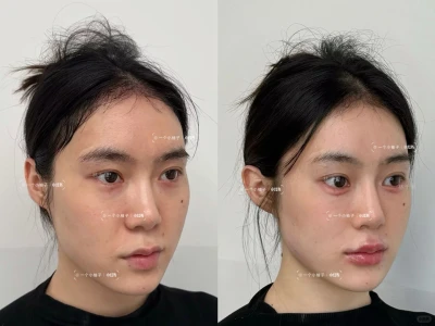 侧面瞧瞧饱满了眼周和面中