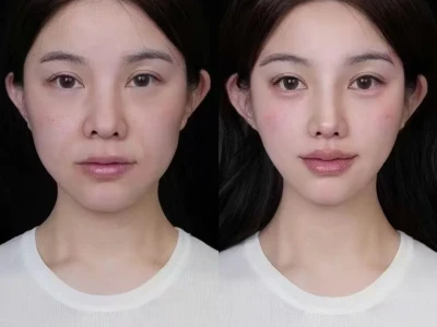 骨相妈生脸前后对比🆚