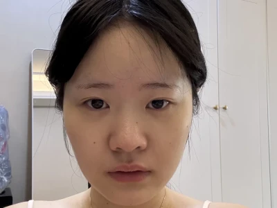 方圆脸瘦脸针效果