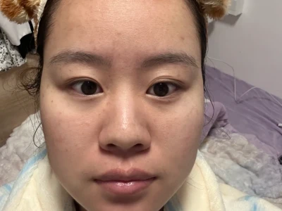 医美小白第一次光子嫩肤DAY5!