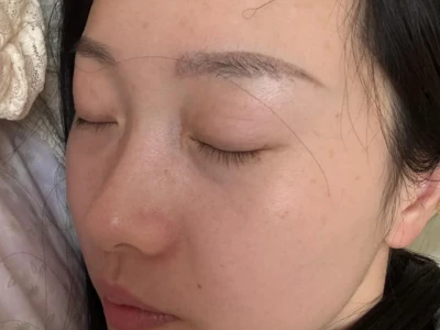 04年女大，打卡三个月，雀斑没了