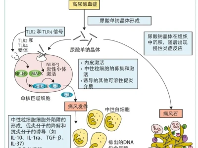 痛风(高尿酸)药物开发的多个研报解读