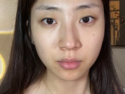 25岁阔面小方脸打瘦脸针