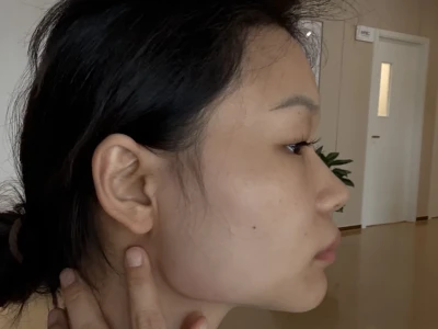 瘦脸 肉毒素